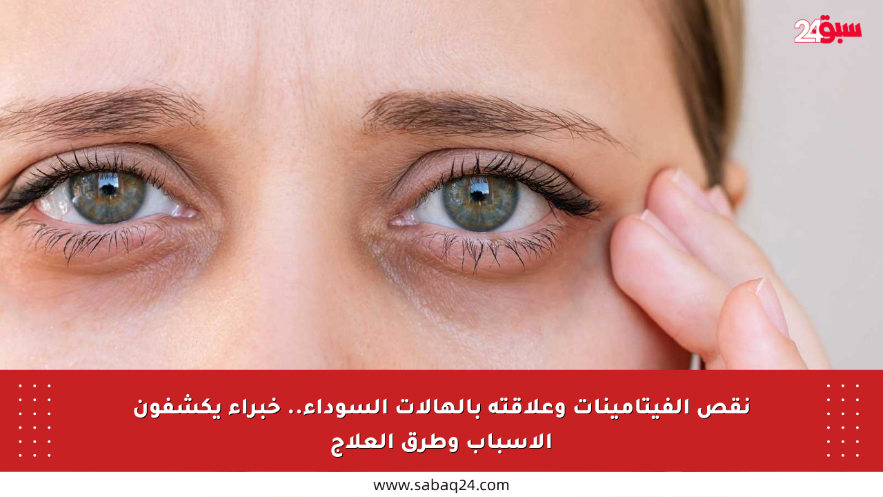 نقص الفيتامينات وعلاقته بالهالات السوداء.. خبراء يكشفون الأسباب وطرق العلاج